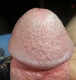 Снимка на увеличения пенис на главата