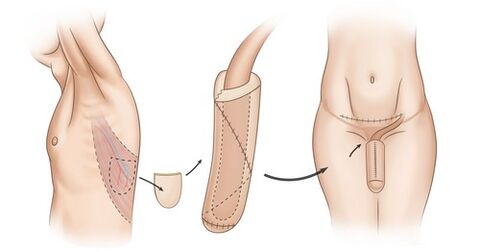 мускулна трансплантация за уголемяване на пениса