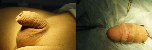 пенис преди и след операция за уголемяване
