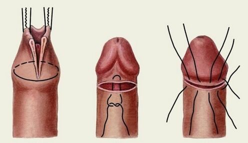 същността на операцията за уголемяване на пениса