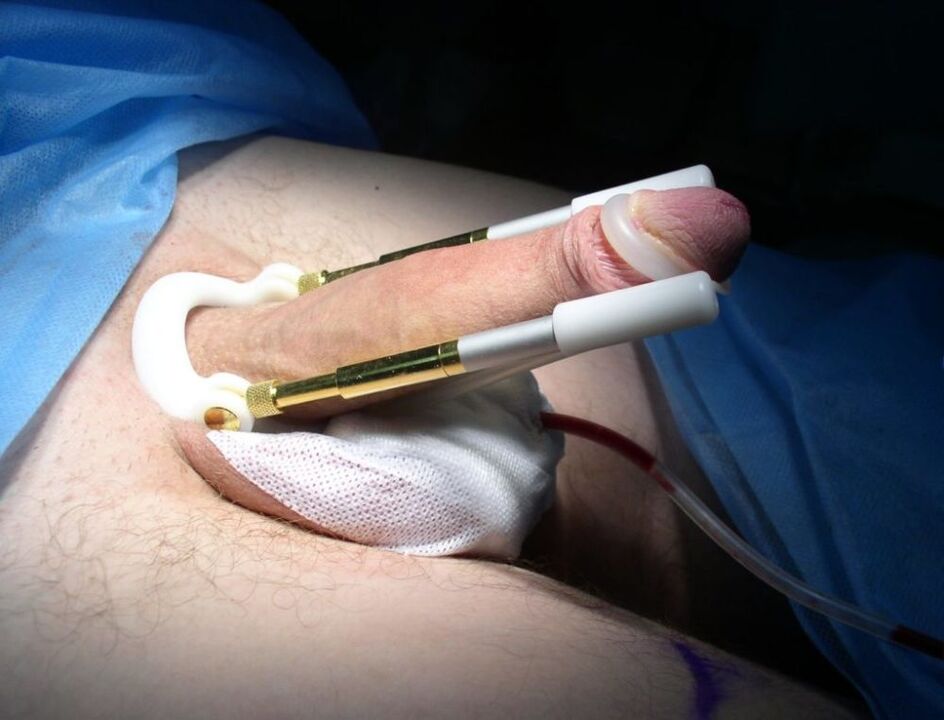 удължител след операция за уголемяване на пениса