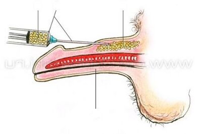 инжекционно уголемяване на пениса
